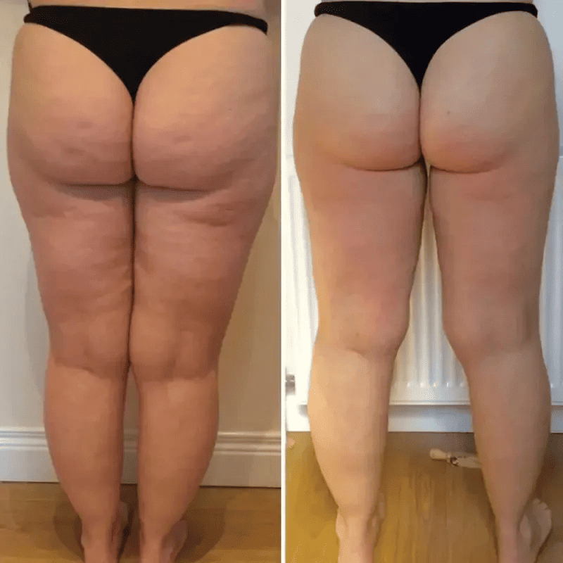 BelleLift Sculpt™ – Tecnologia 3 em 1 Contra Flacidez, Celulite e Estrias