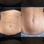 BelleLift Sculpt™ – Tecnologia 3 em 1 Contra Flacidez, Celulite e Estrias