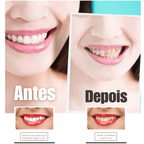 SmileKit – Clareamento total em 30 minutos