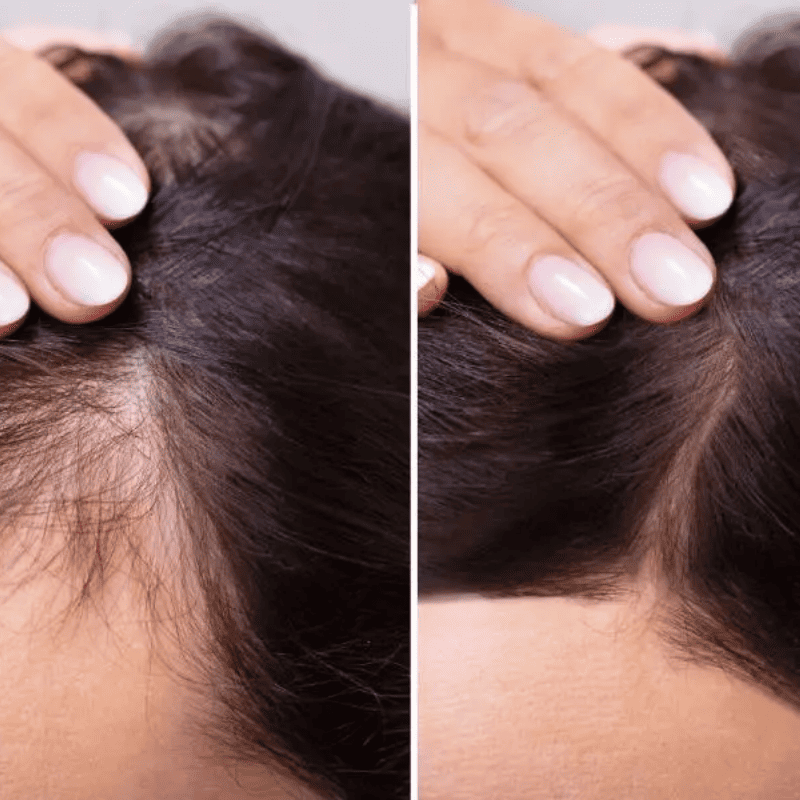 Escova Massageadora BelleHair™ - Crescimento Capilar Intensivo + Brinde