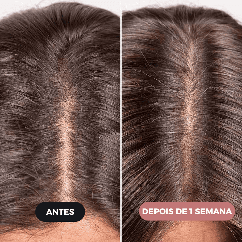 Escova Massageadora BelleHair™ - Crescimento Capilar Intensivo + Brinde