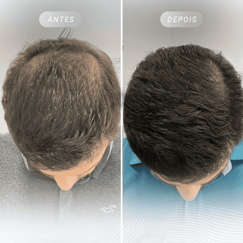 Escova Massageadora BelleHair™ - Crescimento Capilar Intensivo + Brinde